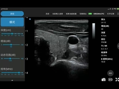 Ασύρματος έλεγχος υπερήχου μετατροπέων υπερήχου Ipad 256 γραμμών ανίχνευσης για PICC